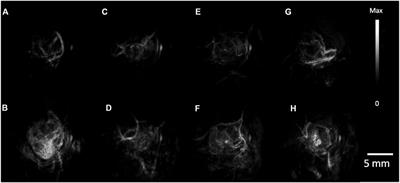 Progress of photoacoustic imaging combined with targeted photoacoustic contrast agents in tumor molecular imaging